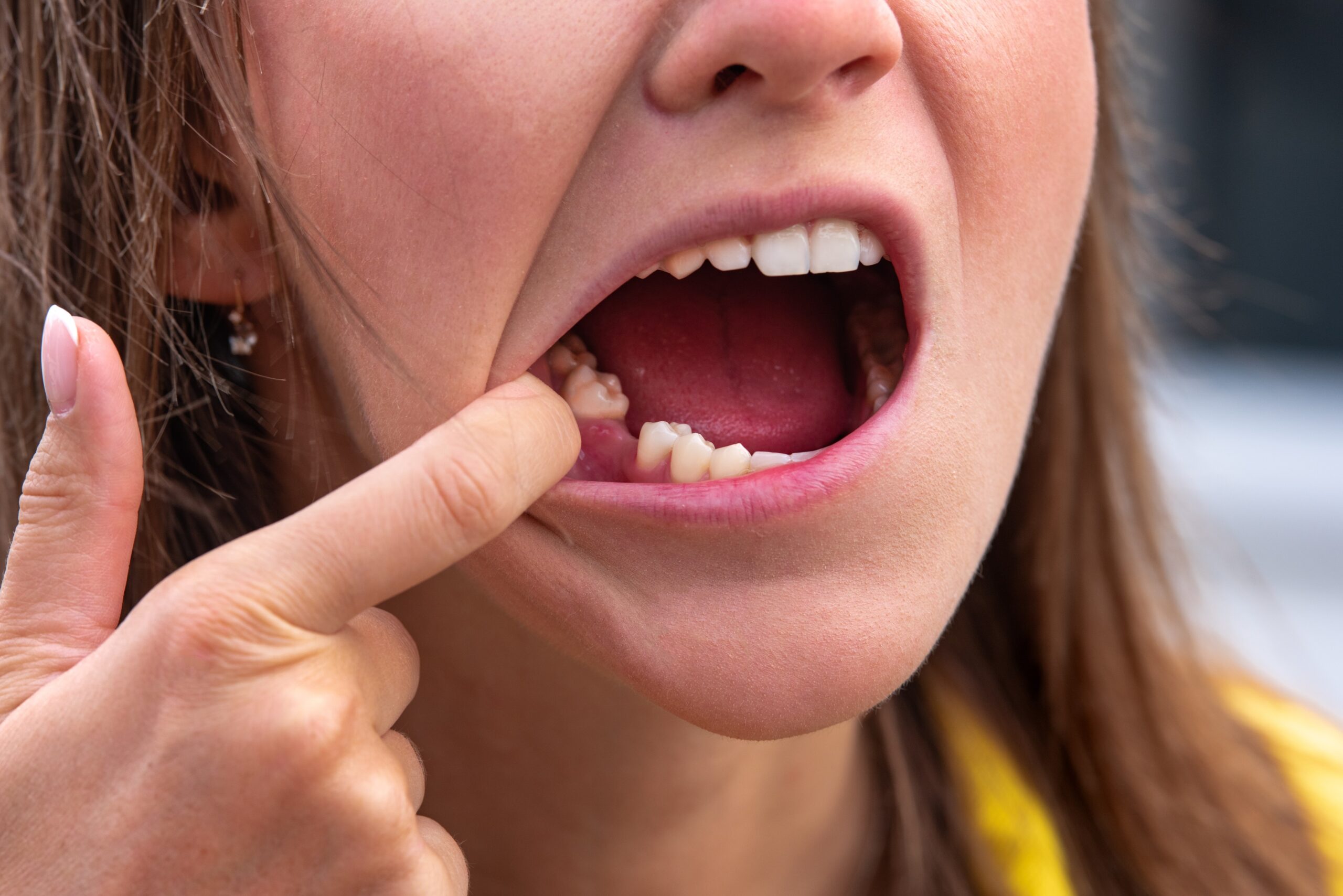 Congenital Missing Teeth 101 in Brooklyn NY