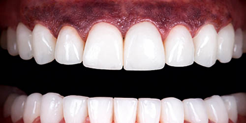 Gum pigmentation laser treatment in Brooklyn New York